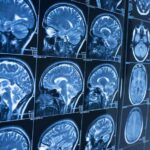 How Neuroradiology Assists in Diagnosing Memory-related Conditions