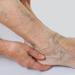 Varicose Veins: Can Exercise and Diet Help Alleviate Symptoms?