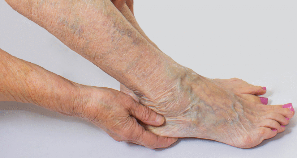 Varicose Veins: Can Exercise and Diet Help Alleviate Symptoms?