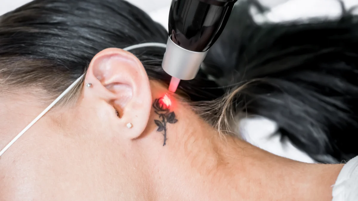 What To Expect During the Tattoo Removal Process