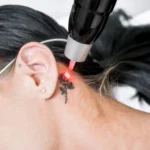 What To Expect During the Tattoo Removal Process