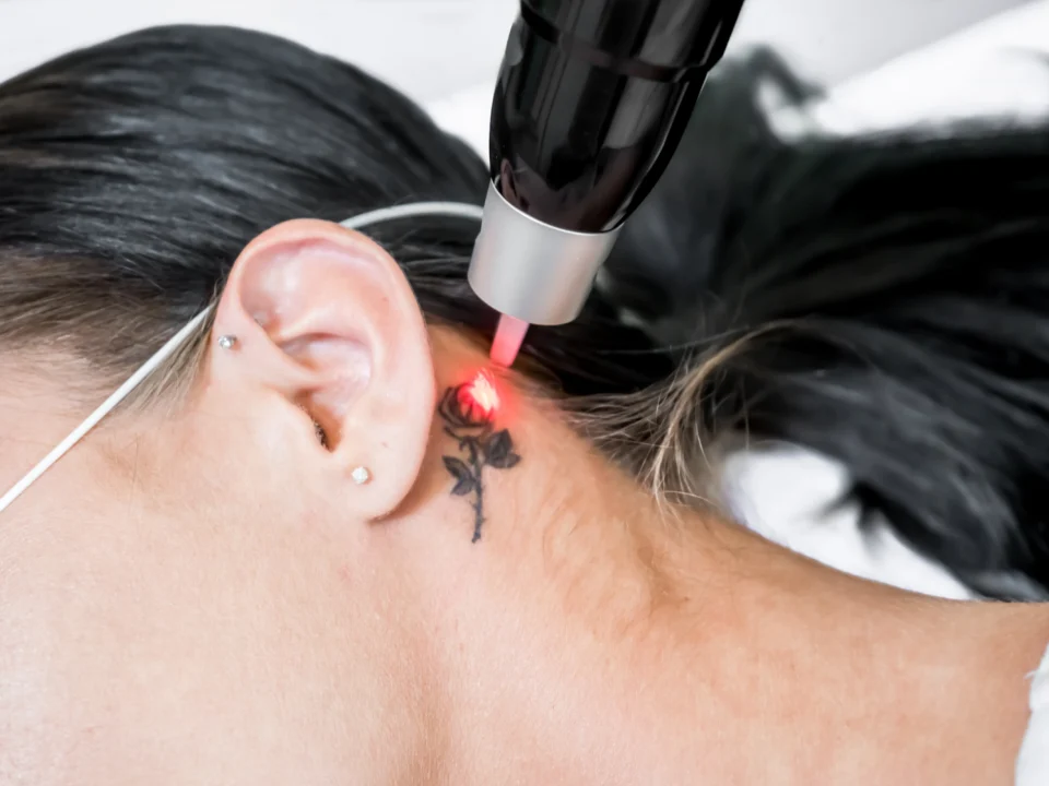 What To Expect During the Tattoo Removal Process