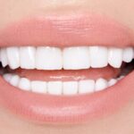 The Different Types of Veneers and Their Unique Benefits