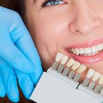 Steps To Prepare for Veneers